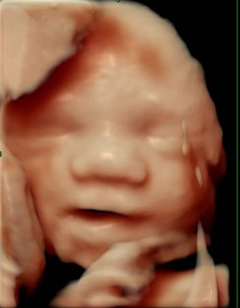 3D-scanning af baby i uge 29 der gaber