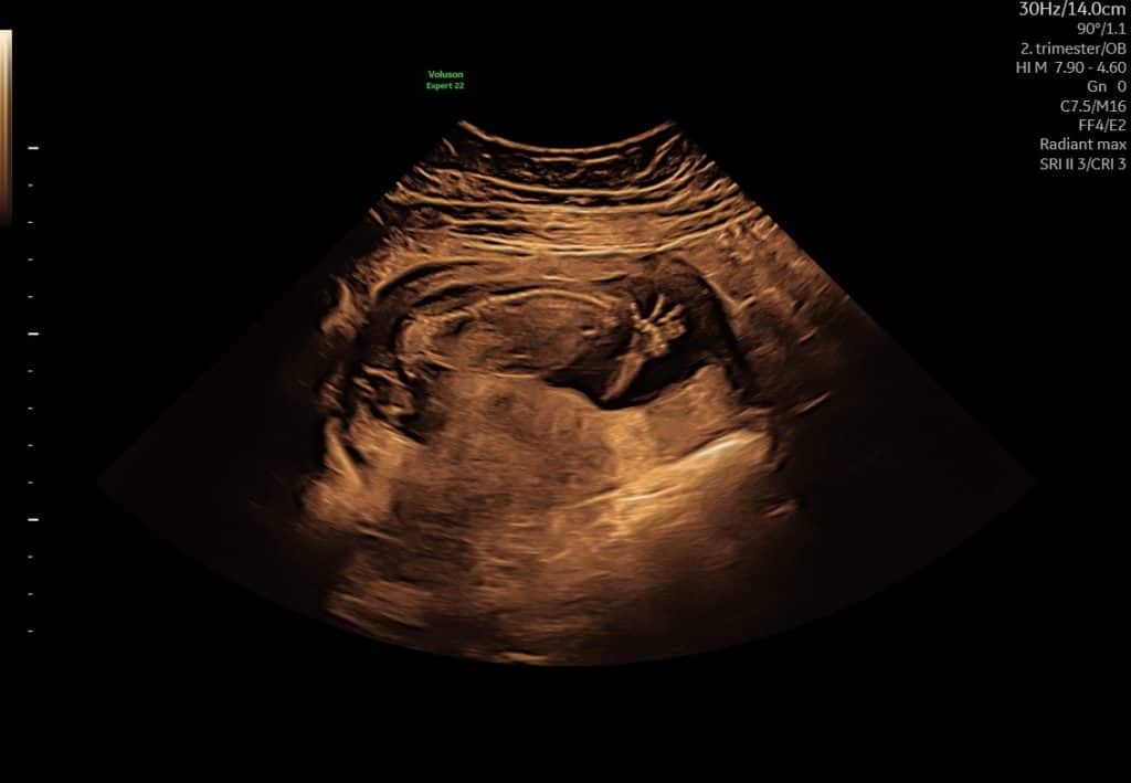 Ultralydsscanning uge 14– foster med fingre