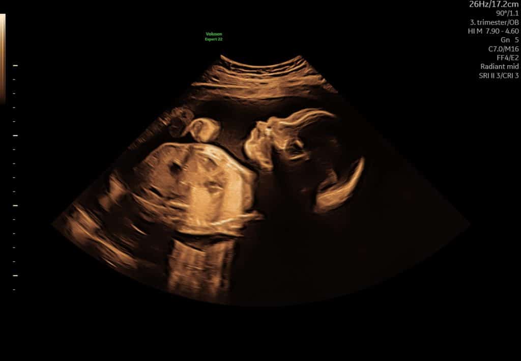 Graviditetsscanning i sen graviditet – baby fylder mere i livmoderen