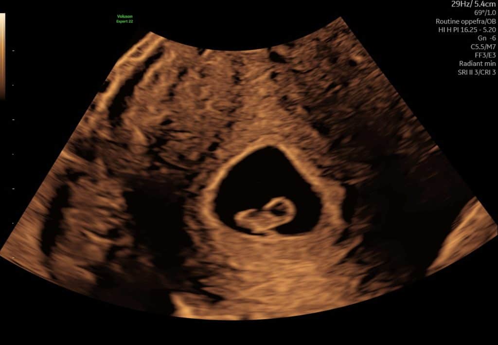 ltralyd i uge 6 – tidlig graviditet med normal variation