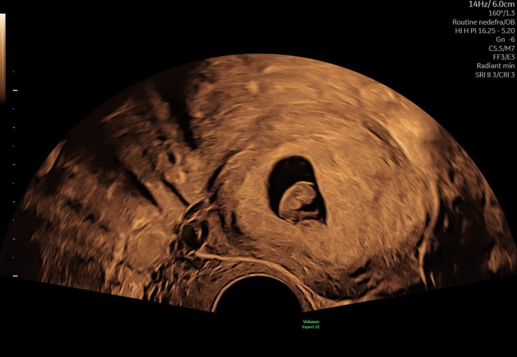 Ultralydsscanning uge 7 – fosteranlæg med hjerteaktivitet