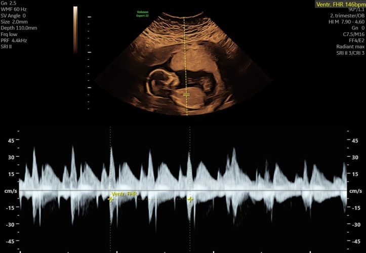Ultralyd scanning i graviditeten